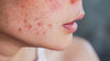 An Ayurvedic Solution for Acne